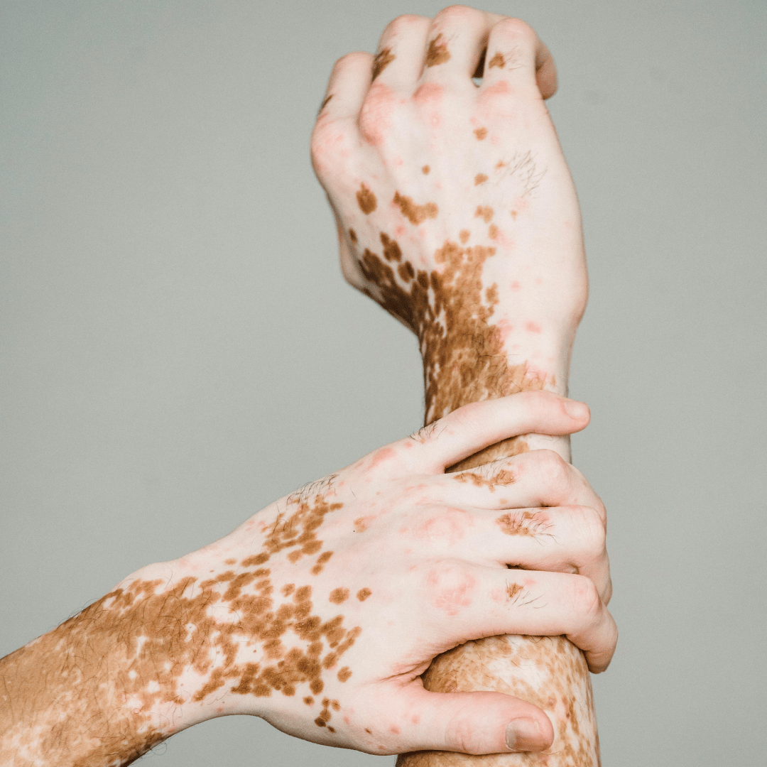 man met witte vlekken